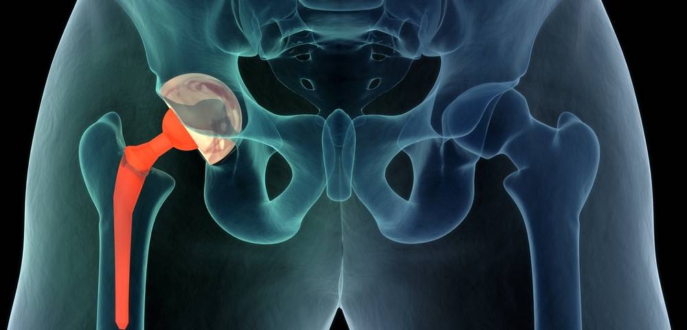 Hip Replacement Surgeon in PCMC