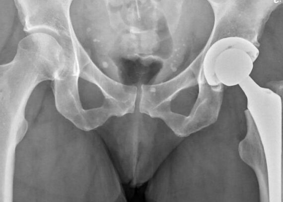 Relieve Pain With This Hip replacement Approach-Dr. Ankur Kumar