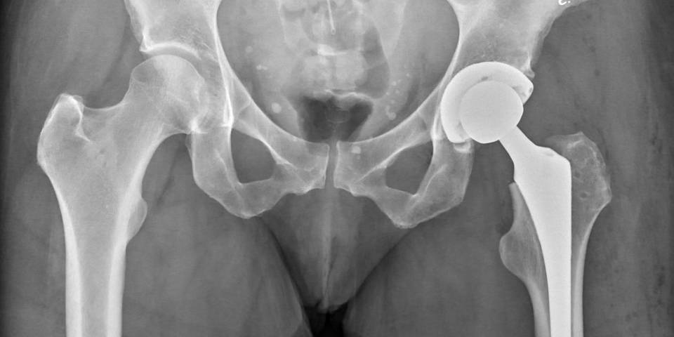 Relieve Pain With This Hip replacement Approach-Dr. Ankur Kumar