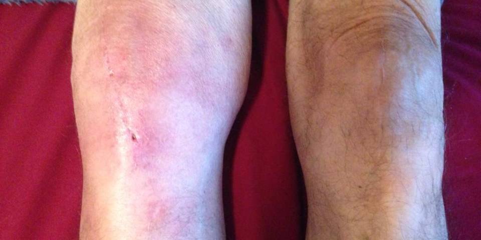 Infection After Joint Replacement